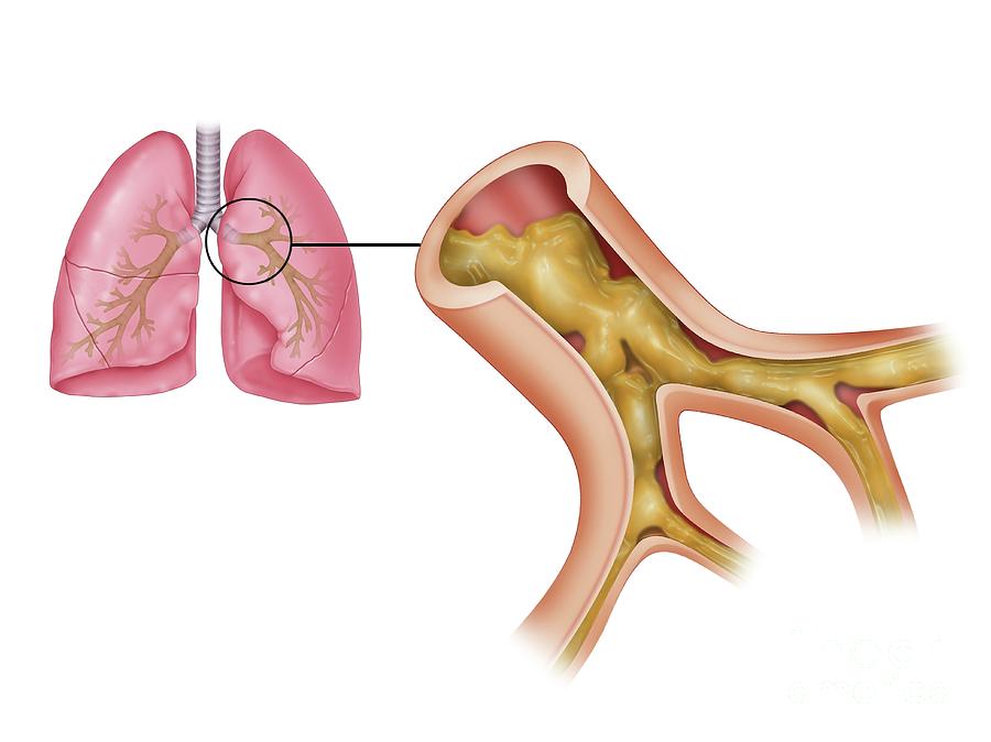 Cystic Fibrosis By Science Photo Library