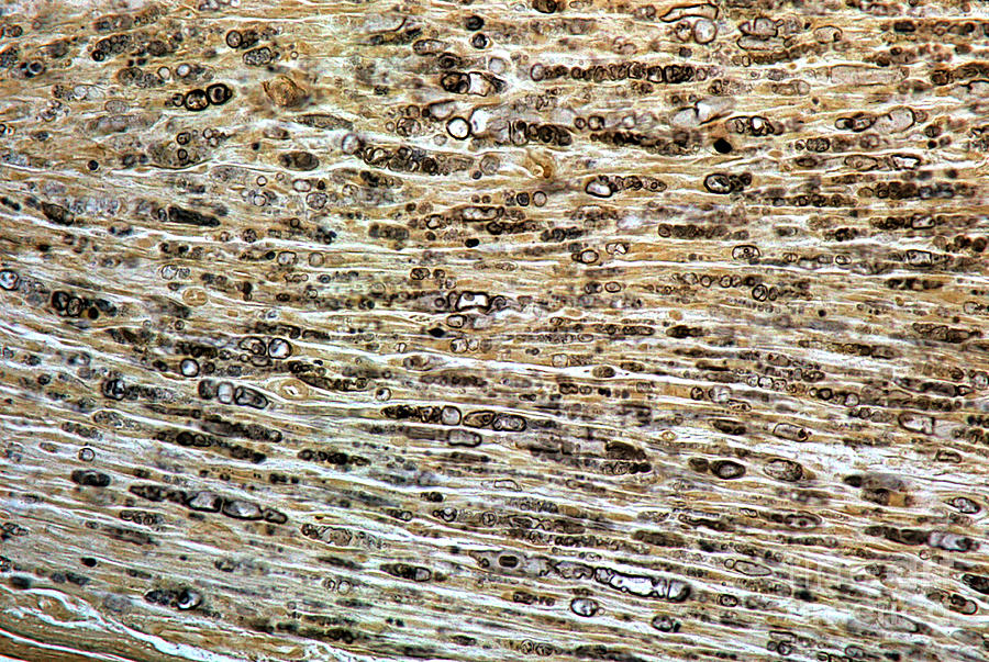 Damaged Myelinated Fibres Photograph by Jose Calvo / Science Photo Library