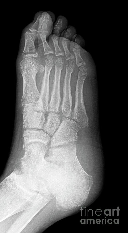 Demineralisation Of Foot Bones Photograph by Science Photo Library ...