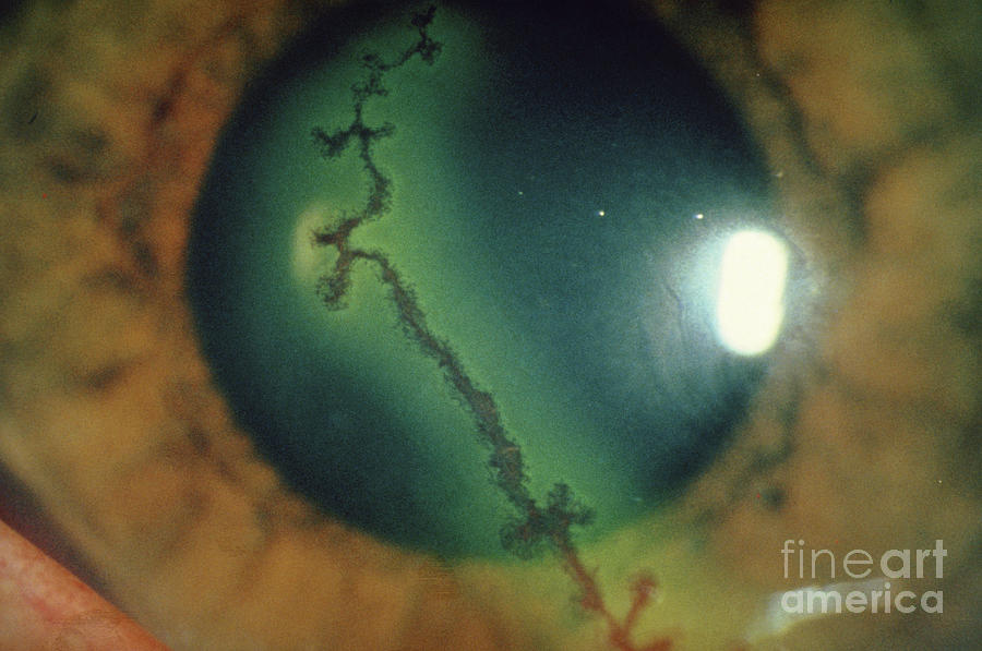 Dendritic Ulcer (herpes Simplex) On Cornea Of Eye Photograph by ...