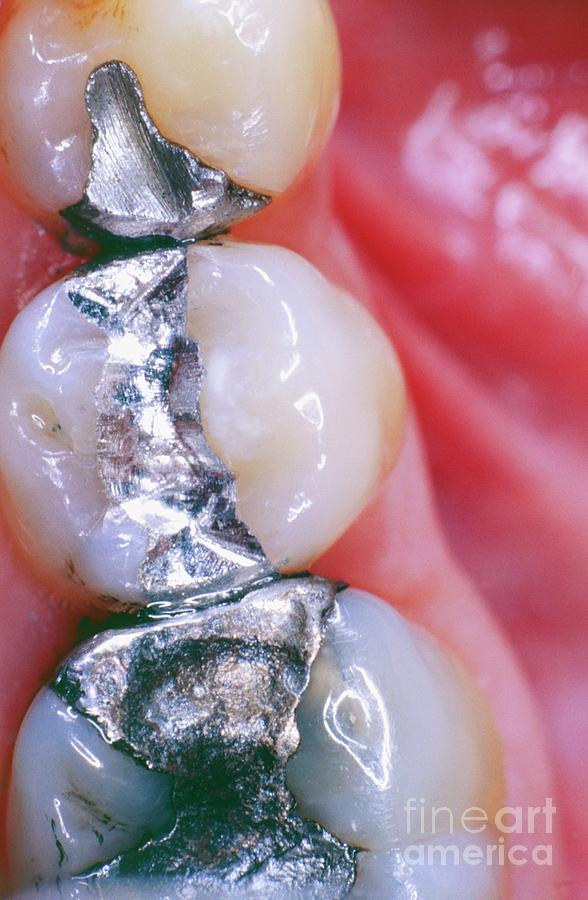 Dental Fillings Photograph by Cnri/science Photo Library