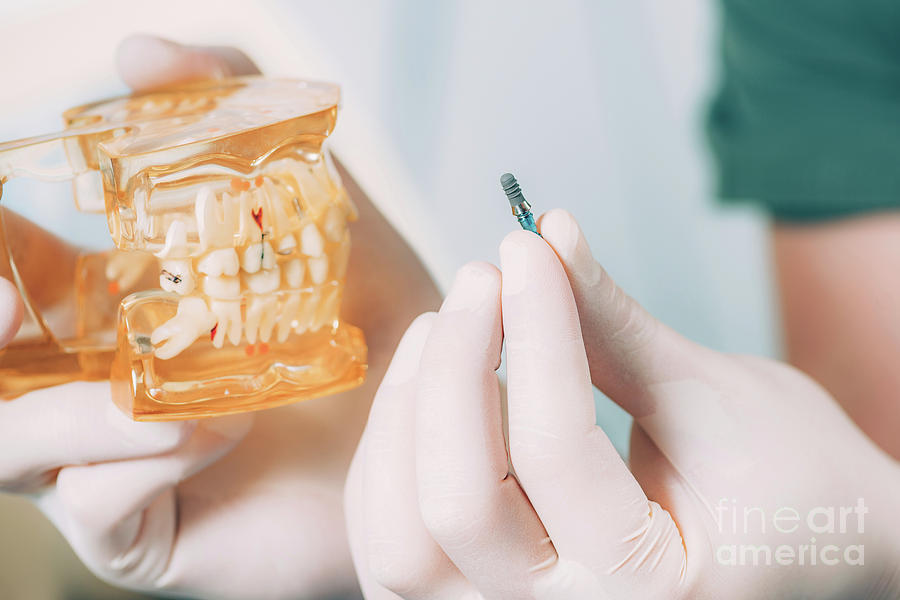 Dentist Holding Dental Implant And Model Jaw Photograph by Microgen Images/science Photo Library
