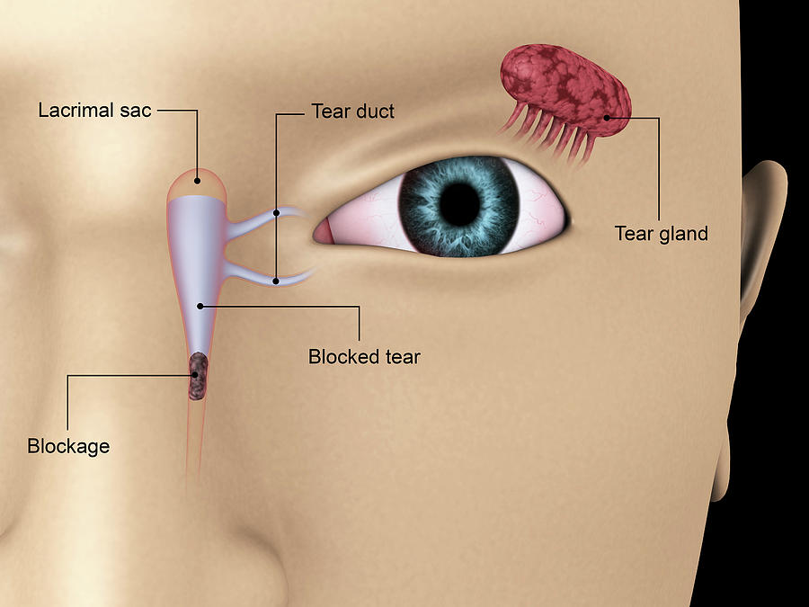 diagram-illustrating-blocked-tear-ducts-photograph-by-stocktrek-images