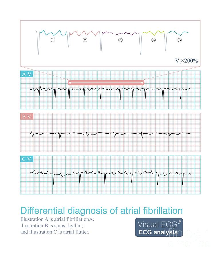 Differential Diagnosis Of Atrial Fibrillation Photograph by Chongqing Tumi Technology Ltd/science Photo Library