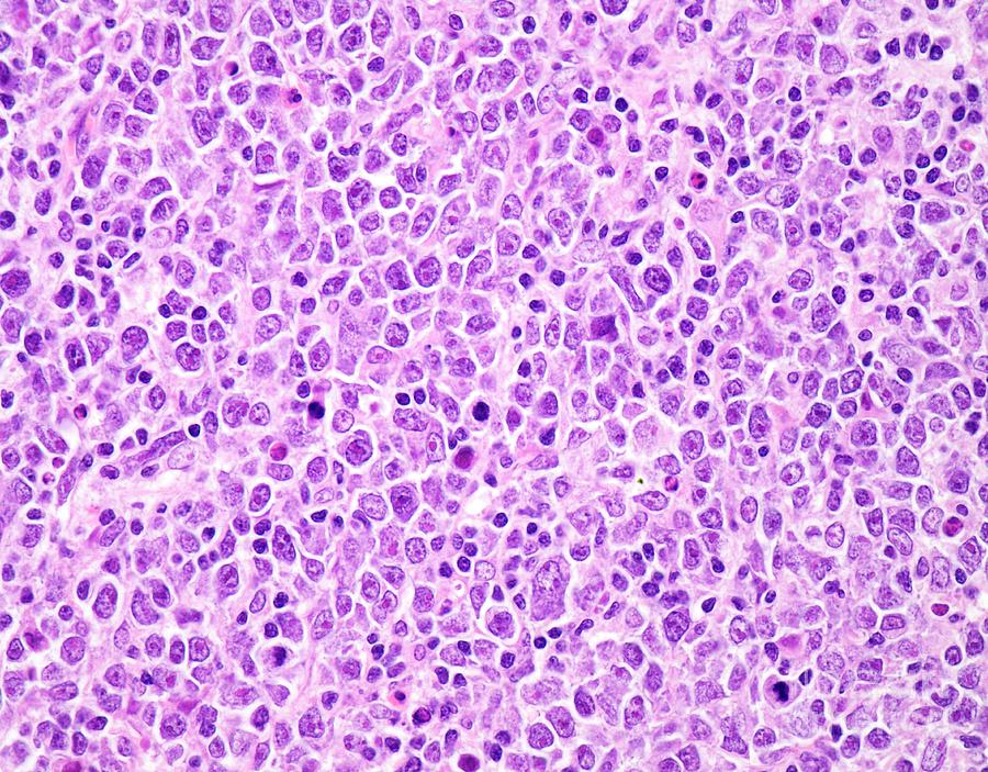 Diffuse Large B-cell Lymphoma Photograph By Webpathology/science Photo ...