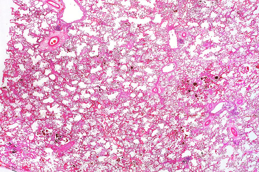 Diseased Lung Photograph by Dr Keith Wheeler/science Photo Library