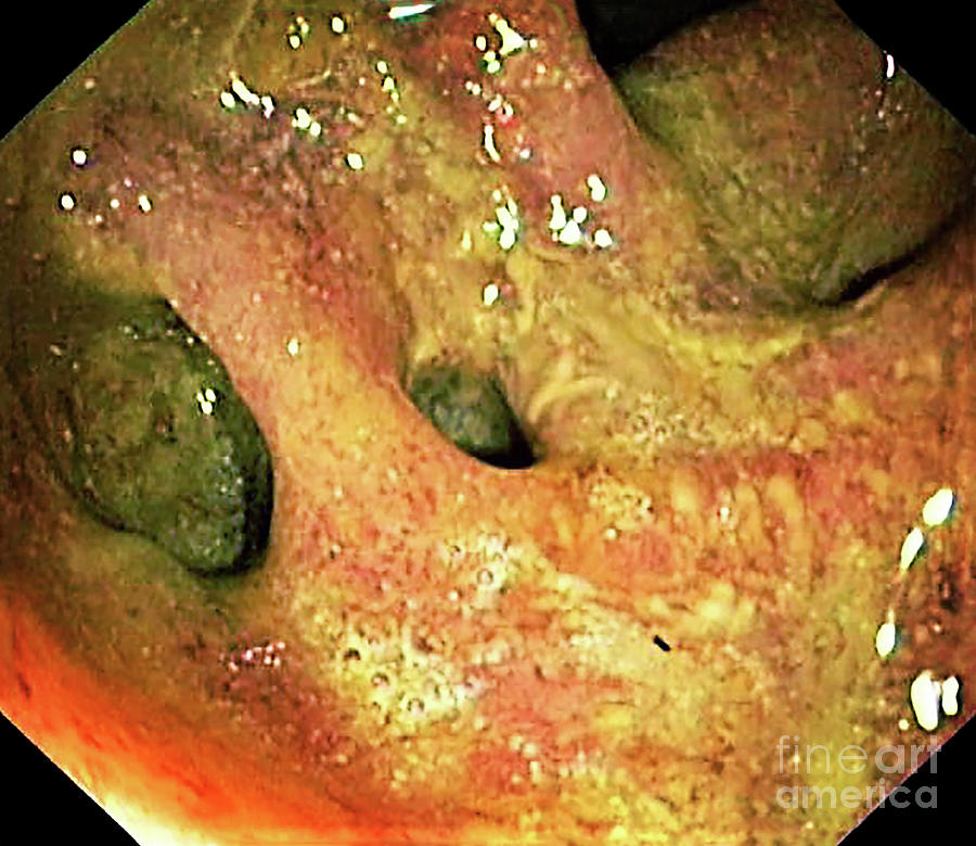 Endoscopy Photograph - Diverticula In Ulcerative Colitis by Gastrolab/science Photo Library