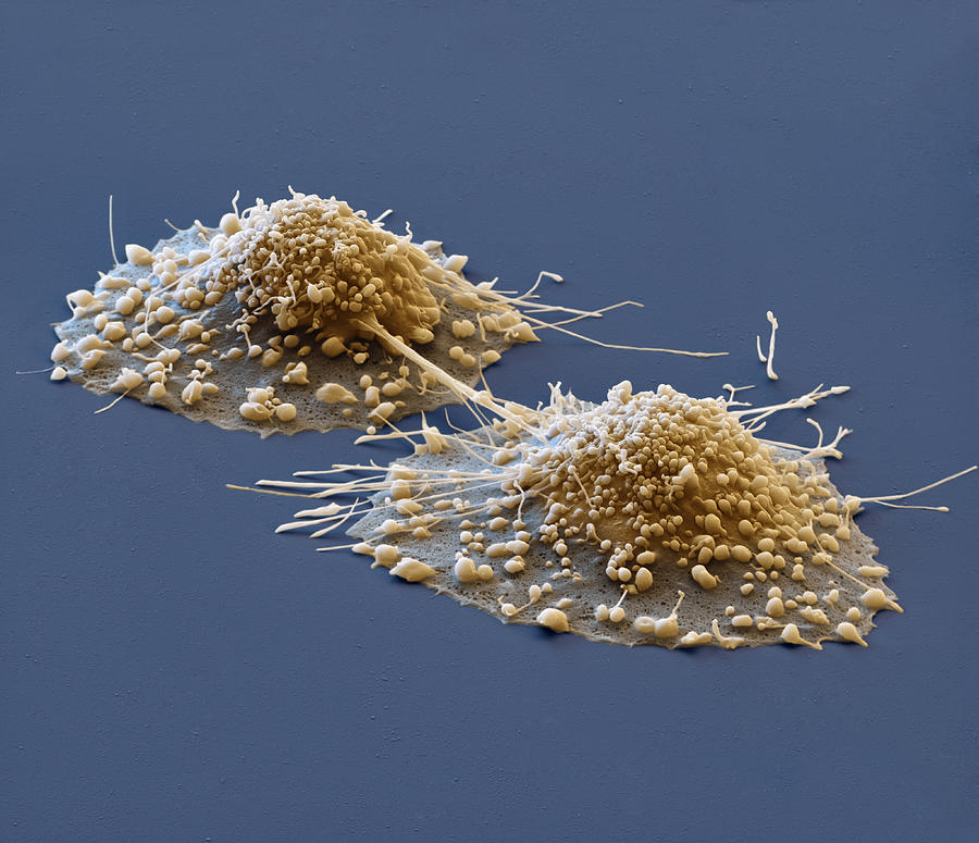 Dividing Cancer Cells Sem Photograph by Meckes/ottawa