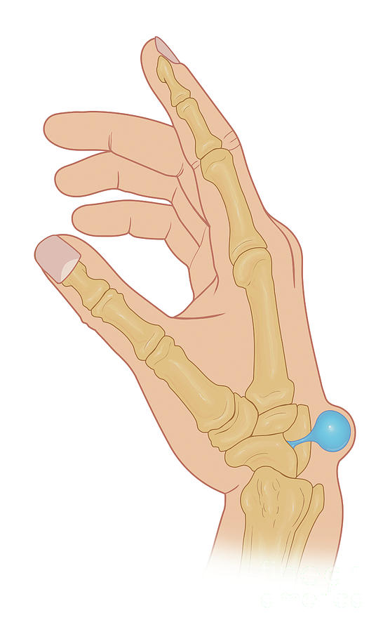 Dorsal Wrist Ganglion Cyst Photograph by Medical Imagery Studios/design ...