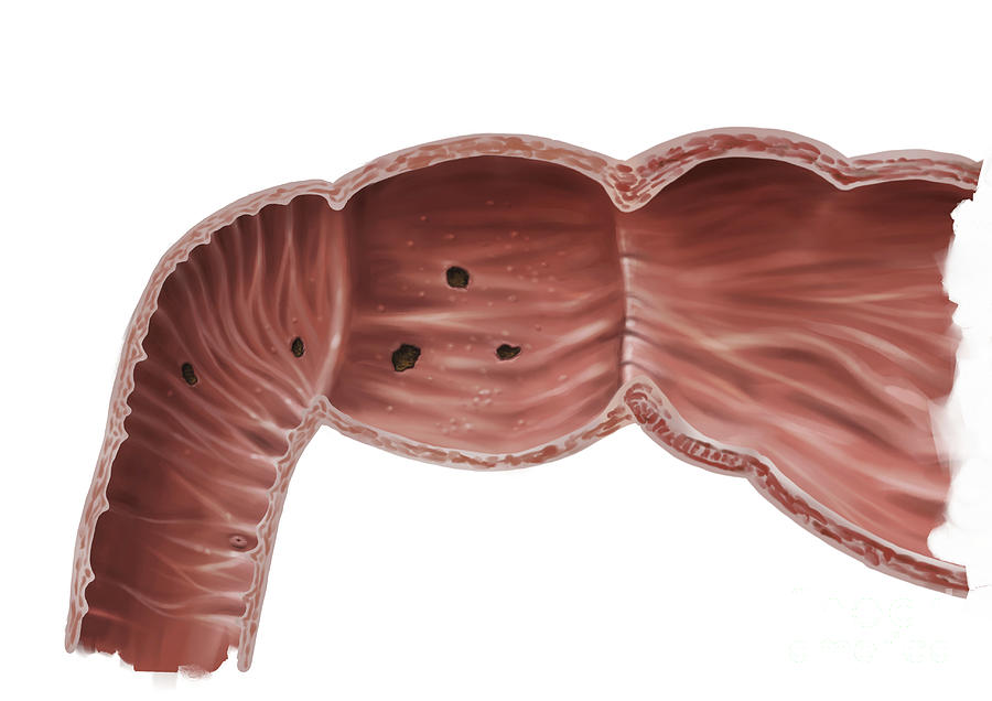 Duodenitis Photograph by Medical Graphics/michael Hoffmann/science ...