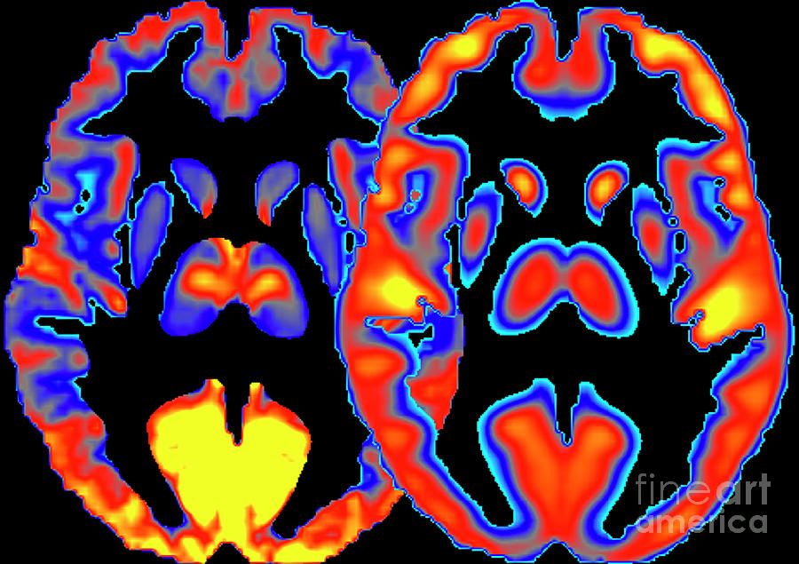 Effects Of Alcohol On The Brain Photograph by National Institutes Of ...