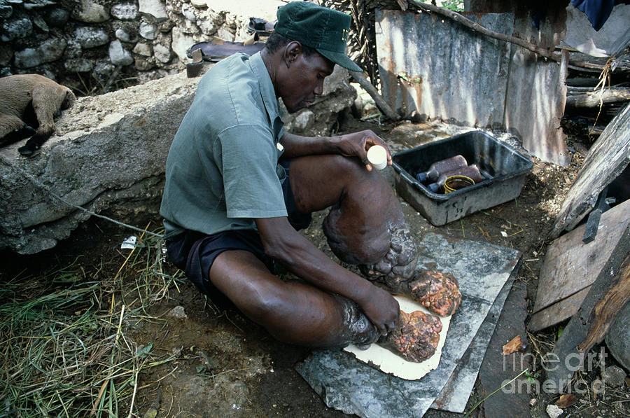 Elephantiasis Hygiene Photograph by Andy Crump, Tdr, Who/science Photo Library