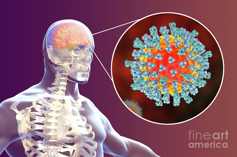 Encephalitis Caused By Measles Viruses Photograph By Kateryna Kon Science Photo Library Fine