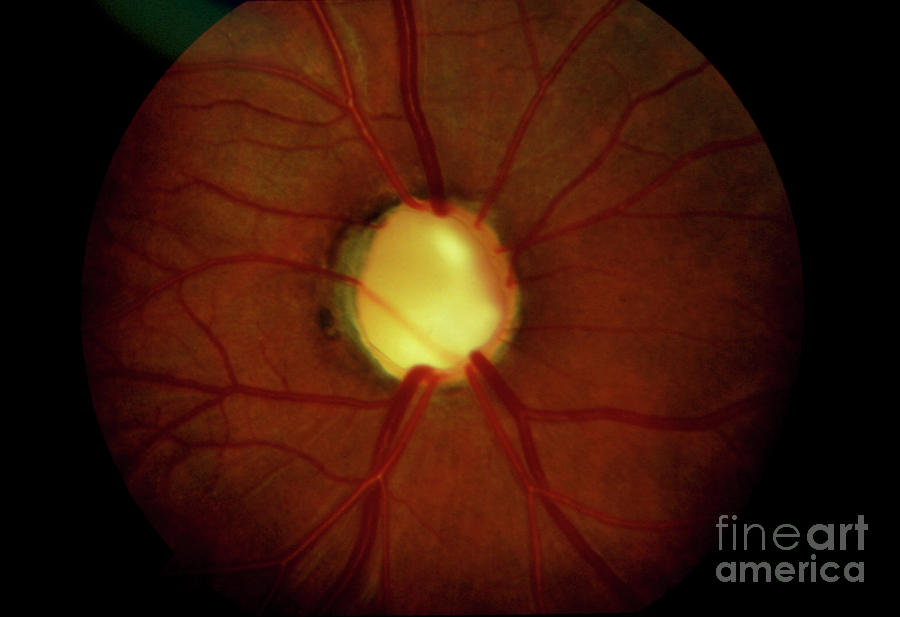 End Stage Glaucoma: Cupping Of Optic Disc Photograph by Western Ophthalmic Hospital/science Photo Library