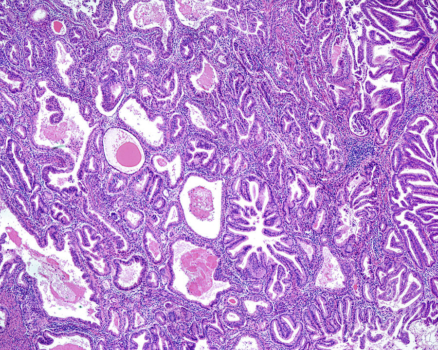 Endometroid Carcinoma by Jose Calvo / Science Photo Library