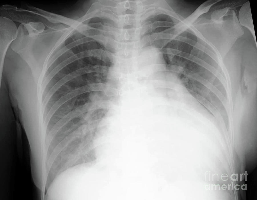 Enlarged Heart And Pulmonary Oedema Photograph by Rajaaisya/science ...