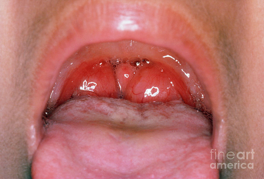 Enlarged Human Tonsils Photograph By St Bartholomew s Hospital science 