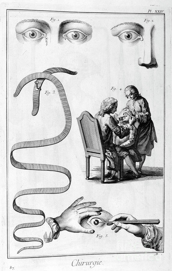 Eye Surgery, 1751-1777 Drawing by Print Collector