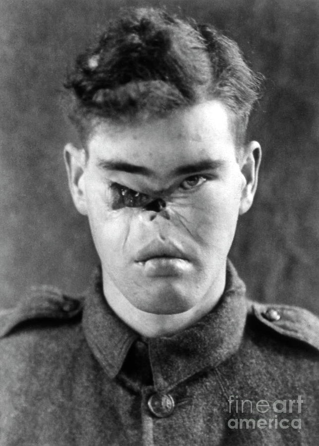 Biological Photograph - Facial Wound On A World War I Soldier by Usa National Library Of Medicine/science Photo Library