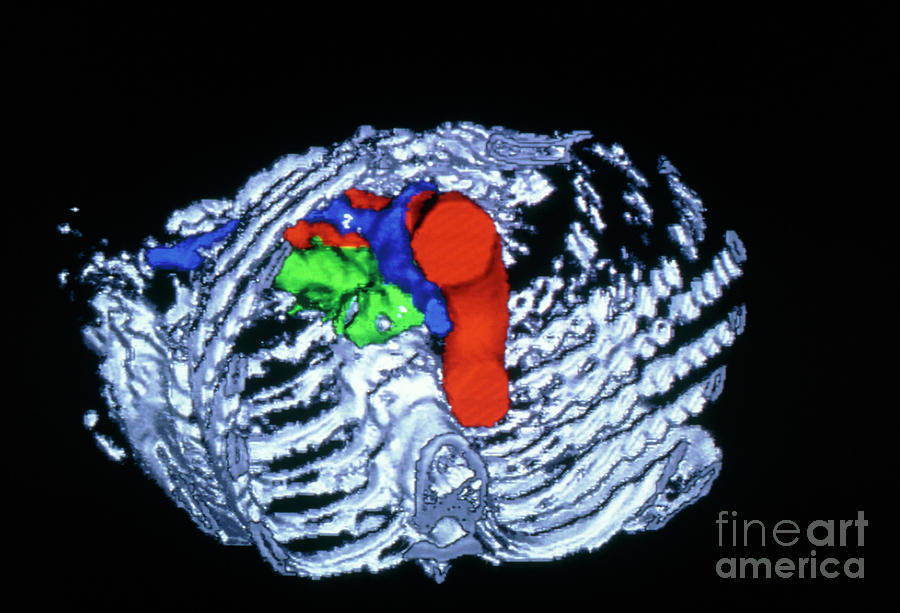 False-colour 3-d Ct Image Of Pancreatic Tumour Photograph by Cnri/science Photo Library