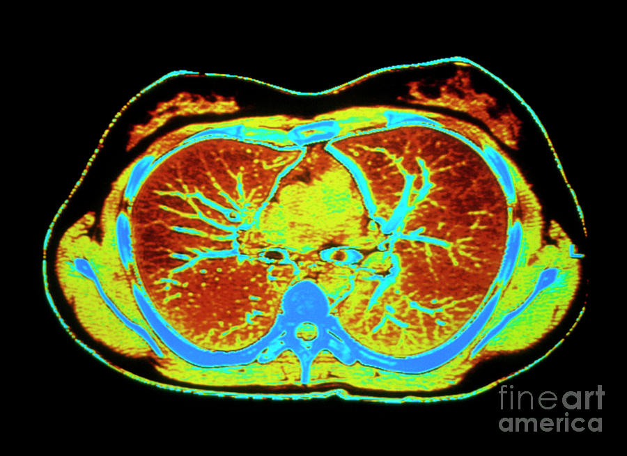 False Colour Ct Scan Of Healthy Chest Photograph by Simon Fraser/science Photo Library