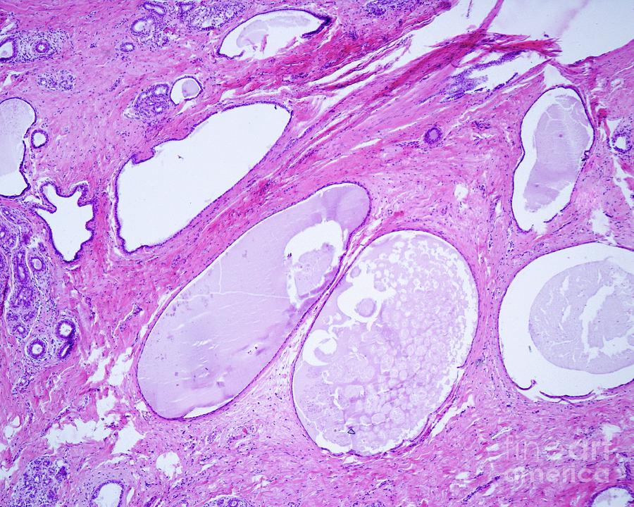 Fibrocystic Breast Disease Photograph by Jose Calvo/science Photo Library