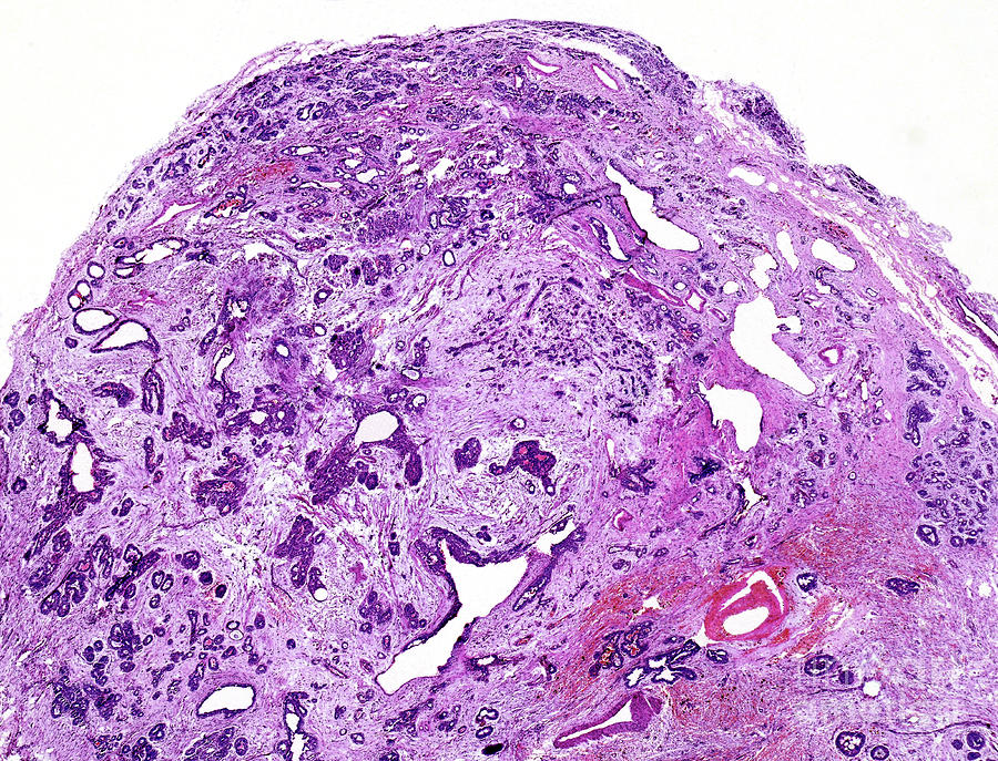 Fibrocystic Disease Of The Breast by Nigel Downer/science Photo Library