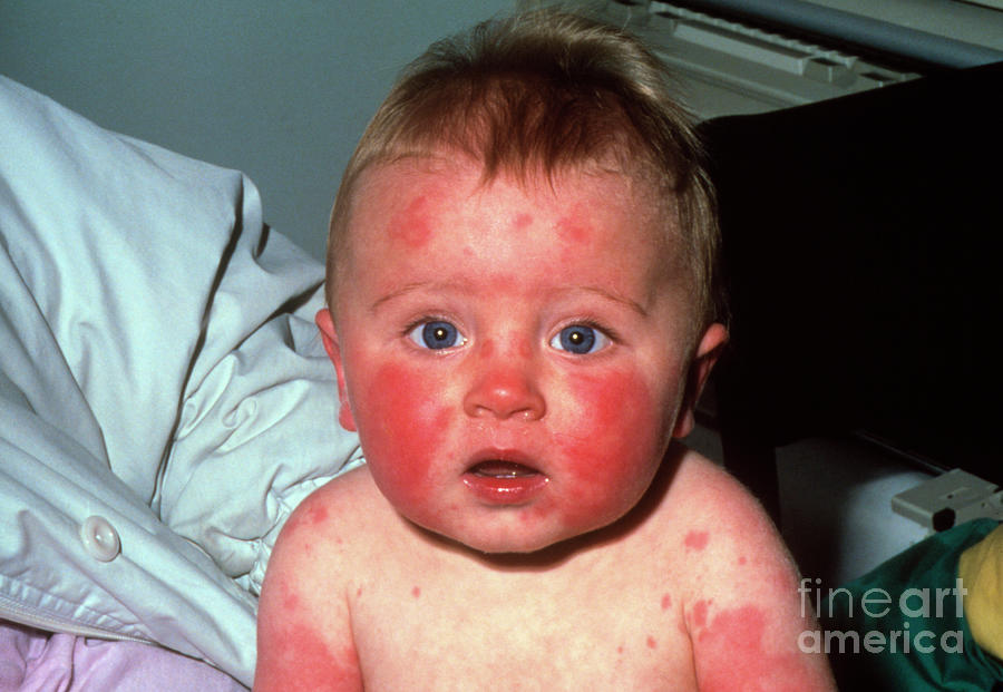 Fifth Disease Slapped Cheek Marks On Inf Photograph By Dr H C Robinson Science Photo Library