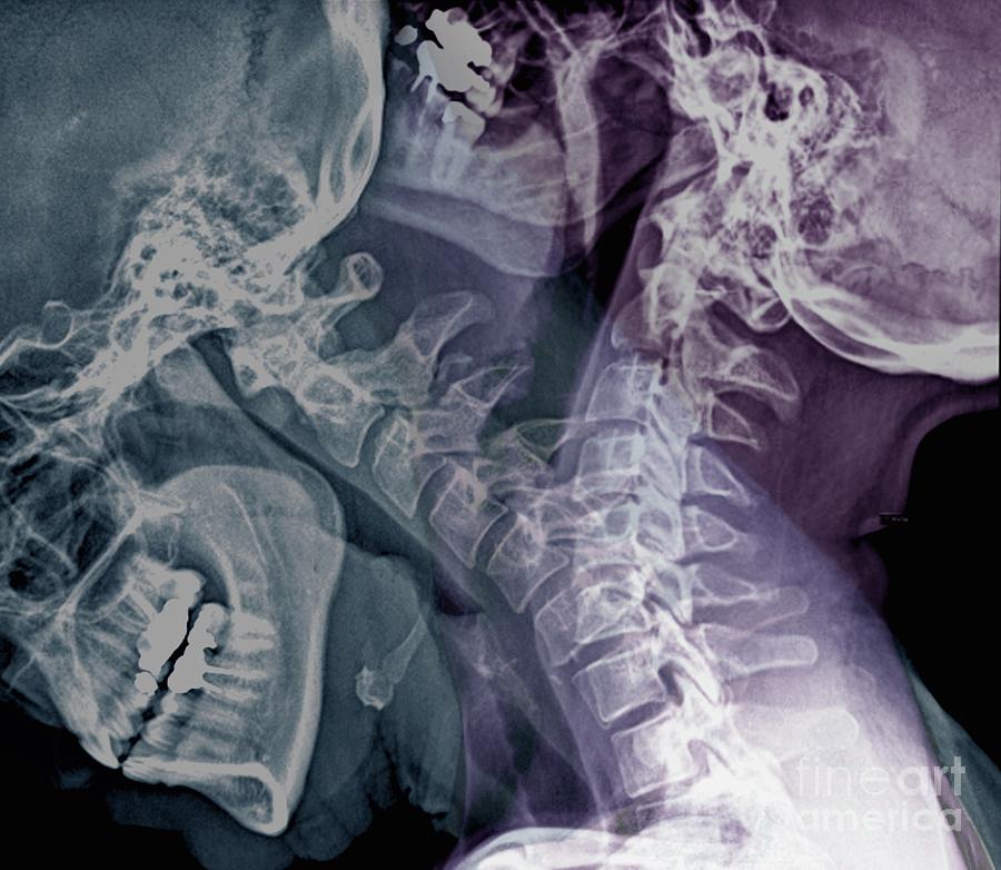 Flexion Of The Cervical Spine Photograph by Zephyr/science Photo Library