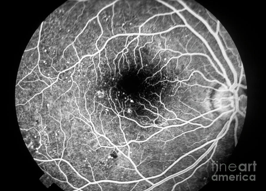 Fluorescein Angiogram In Diabetic Retinopathy Photograph by Western ...