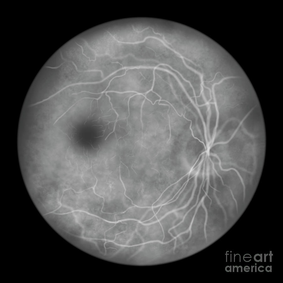 Fluorescein Angiogram Of An Eye Retina Photograph by Kateryna Kon ...