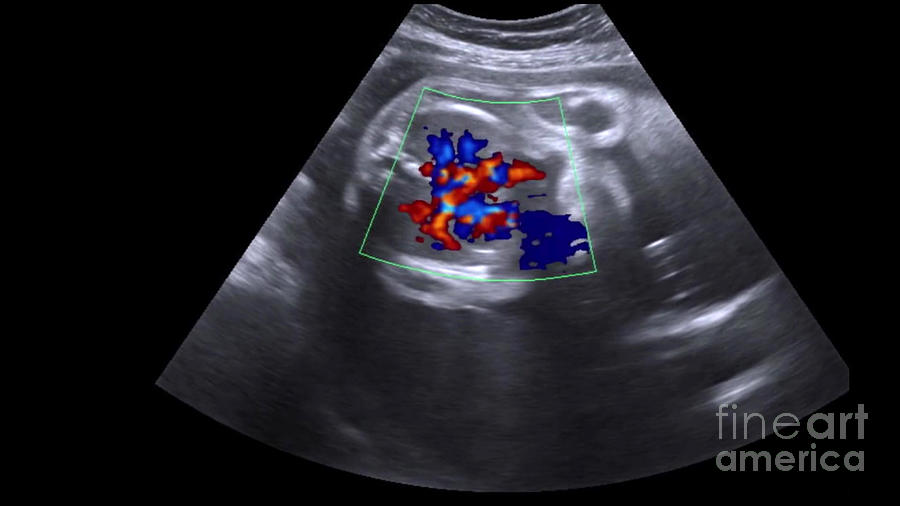 Foetal Heart Photograph by Rajaaisya/science Photo Library