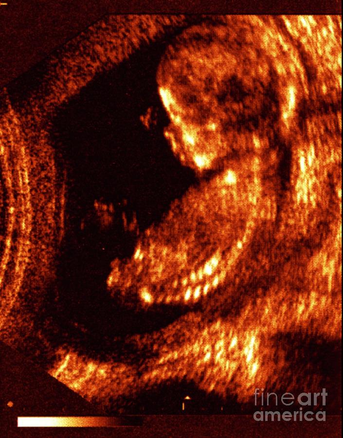 Foetus At 14 Weeks Photograph by Zephyr/science Photo Library
