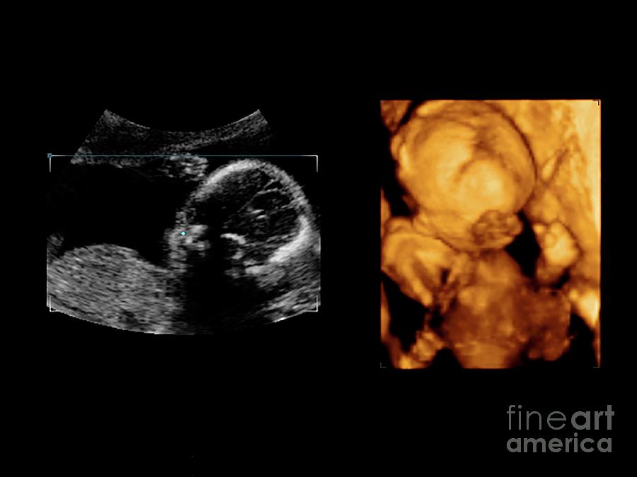 Foetus At 20 Weeks Photograph by Dr Najeeb Layyous/science Photo Library