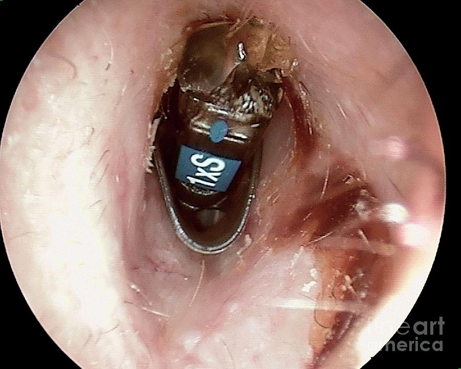 Disease Photograph - Foreign Body In The Ear Canal by Professor Tony Wright, Institute Of Laryngology & Otology/science Photo Library