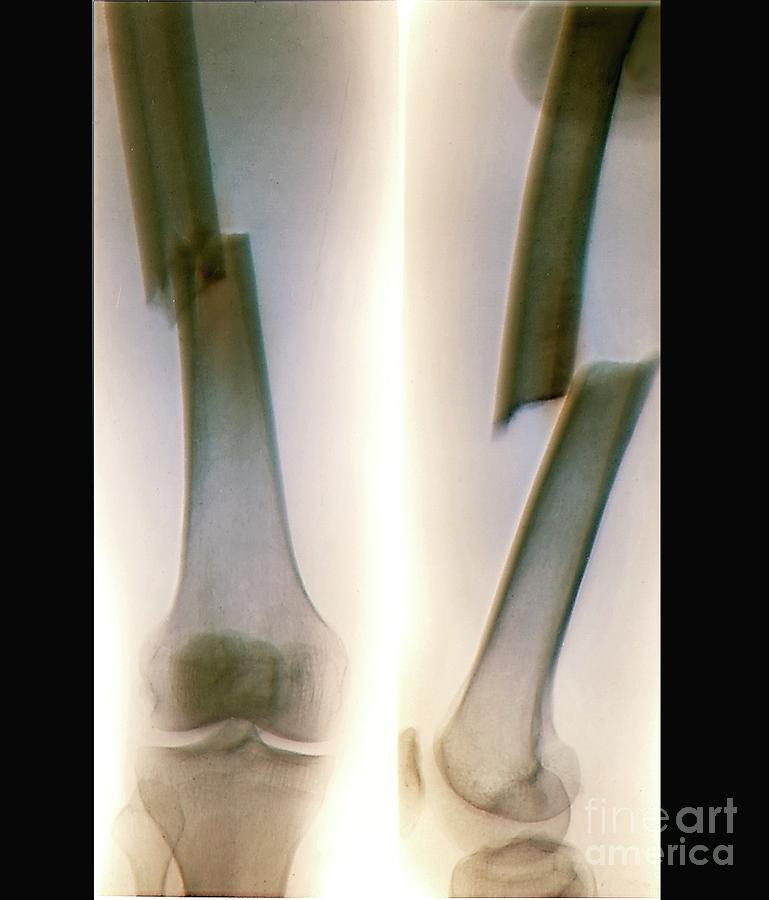 Fractured Femoral Shaft Photograph by Zephyr/science Photo Library