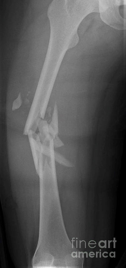 Fractured Femur Photograph by Rajaaisya/science Photo Library - Fine ...