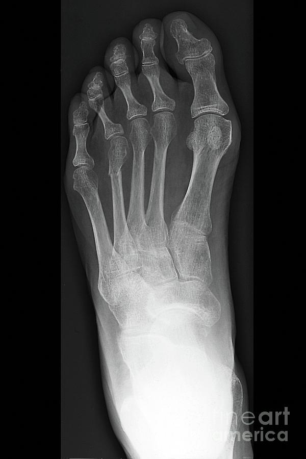 Fractured Metatarsal Foot Bone Photograph by Zephyr/science Photo ...