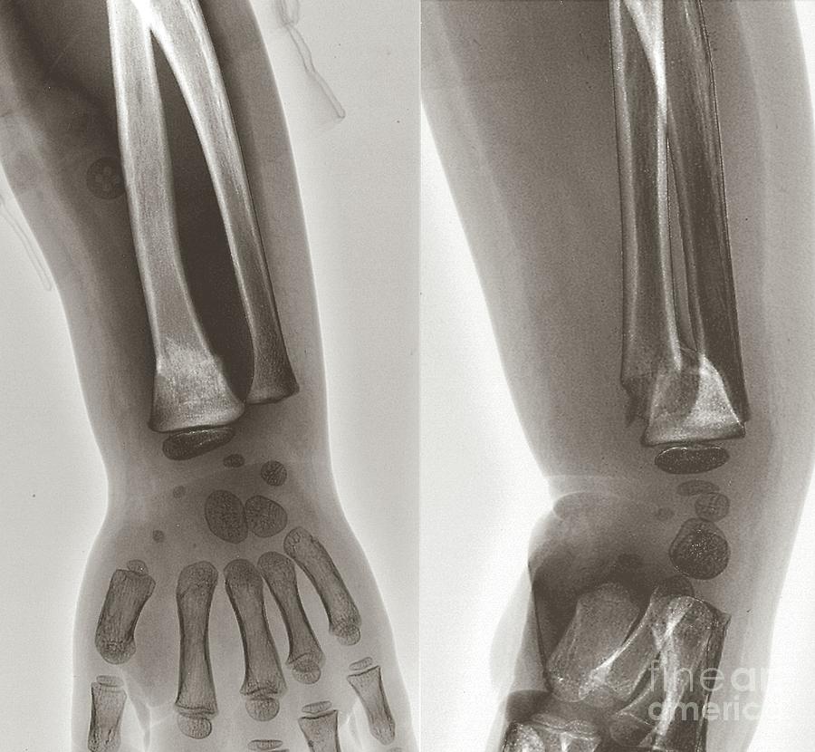 Fractured Radius Bone Photograph by Zephyr/science Photo Library | Pixels