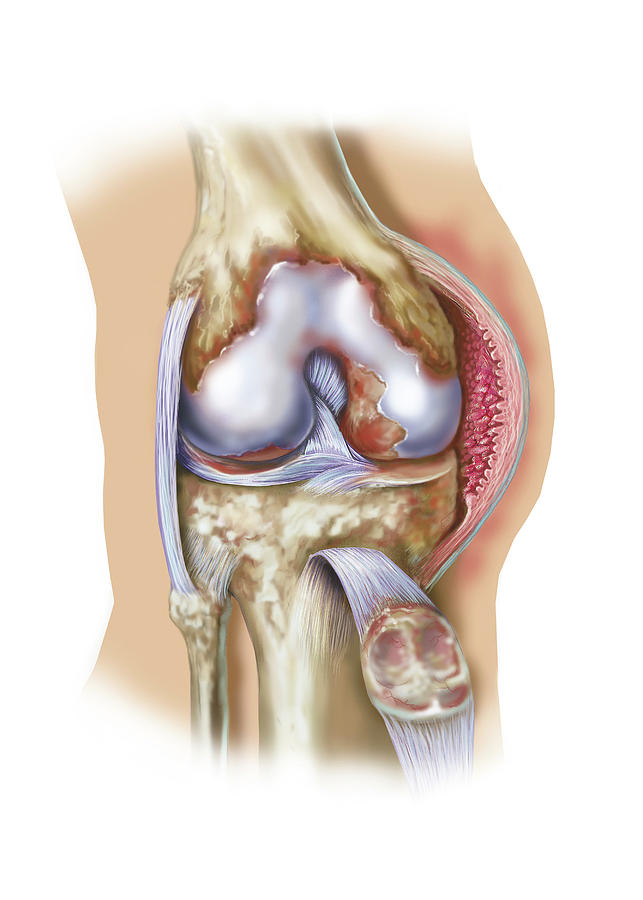 Front View Of Knee Joint Opened To Show Photograph by Elise Walmsley Mac-Wha