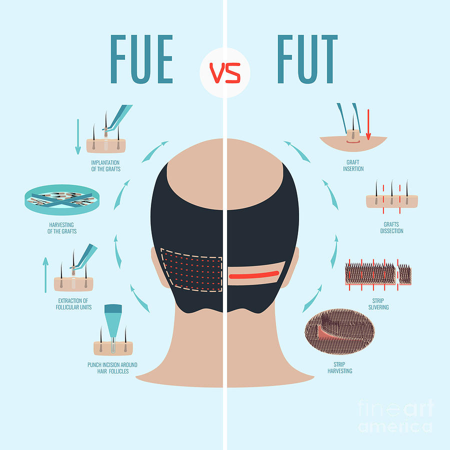 Fue And Fut Hair Loss Treatments Comparison Photograph by Art4stock/science Photo Library