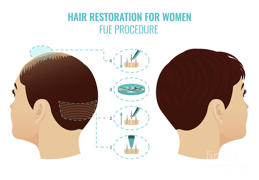 Fue Hair Loss Treatment In Women Photograph by Art4stock/science Photo Library