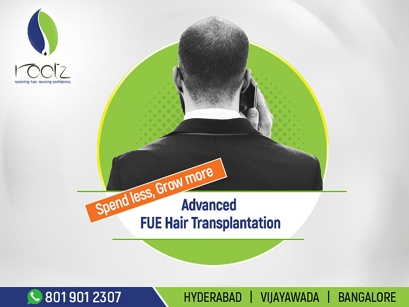 FUE hair transplant in bangalore,hyderabad and vijayawada Digital Art by  Rootz Hair - Fine Art America