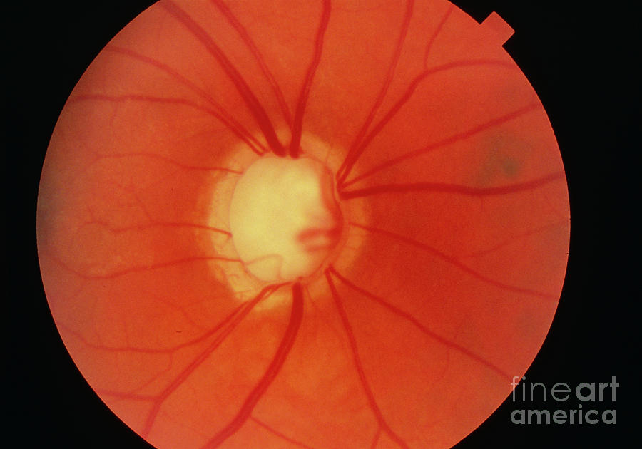 Fundus Camera Image: Cupping Of Disc In Glaucoma Photograph by Western Ophthalmic Hospital/science Photo Library