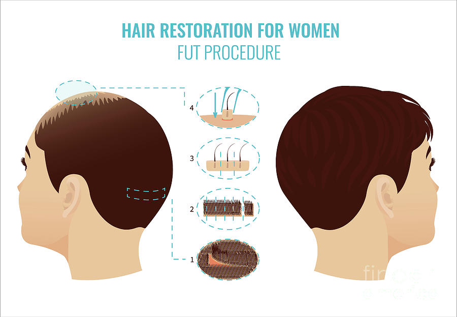 Fut Hair Loss Treatment In Women Photograph by Art4stock/science Photo Library