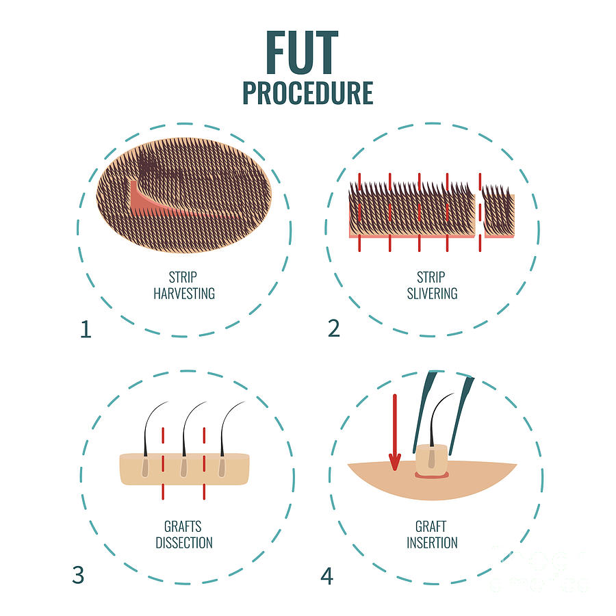 Fut Hair Transplantation Stages Photograph by Art4stock/science Photo Library