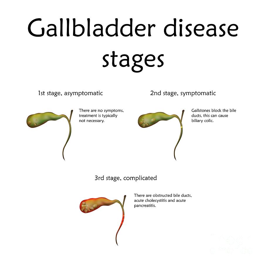 Gallbladder Disease Stages Photograph By Veronika Zakharovascience Photo Library