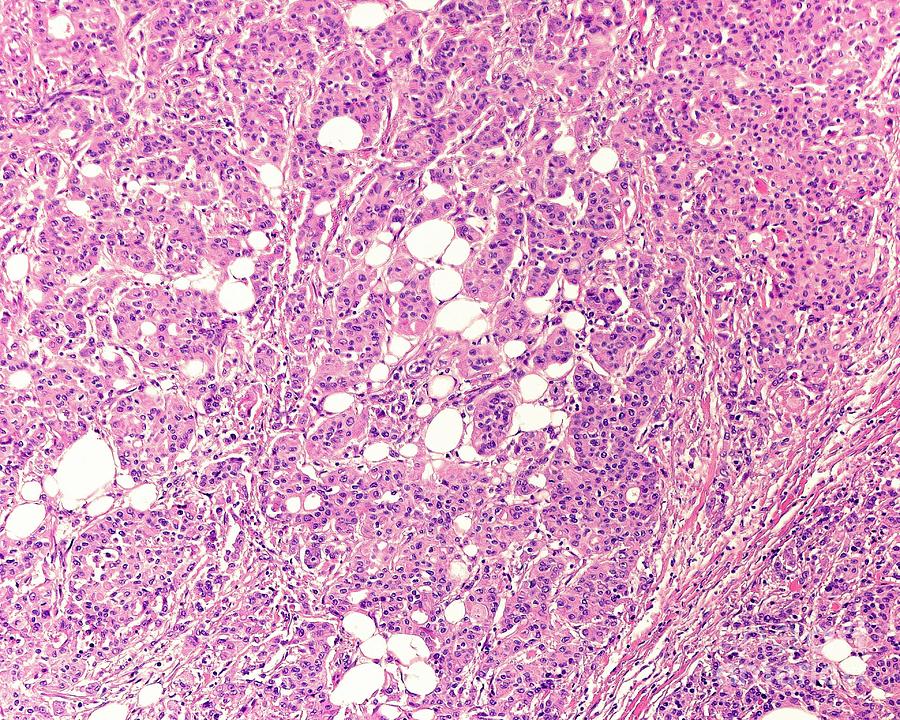 Gastric Adenocarcinoma Photograph by Jose Calvo / Science Photo Library