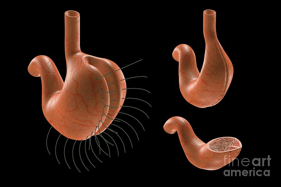 Gastric Plication Surgery Photograph by Patrick Landmann/science Photo ...