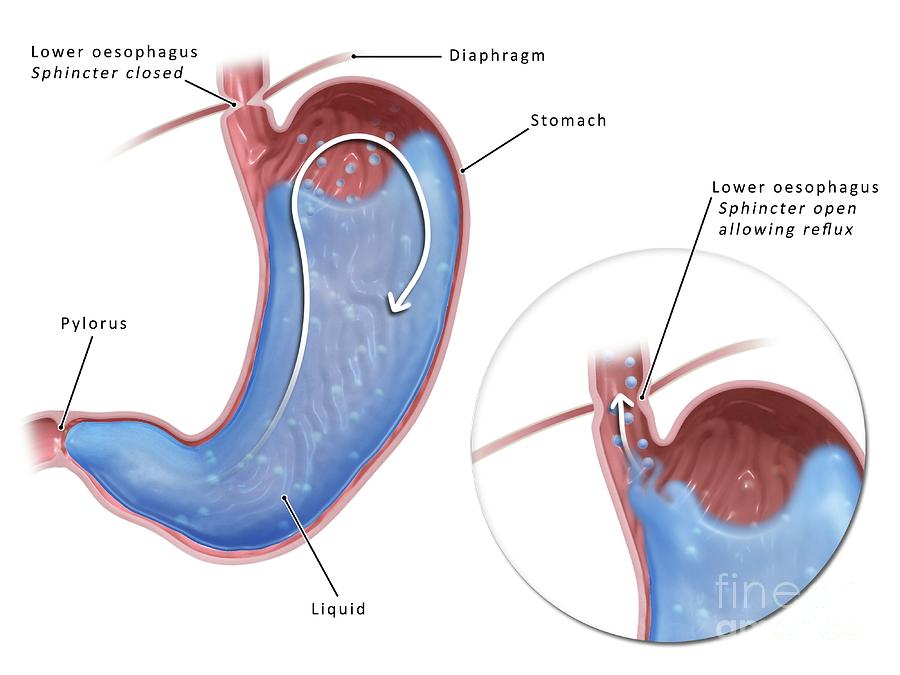 Gastric Reflux Disorders Photograph by Maurizio De Angelis/science ...